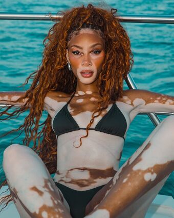 Winnie Harlow Foto Desnuda Filtrada OnlyFans 296