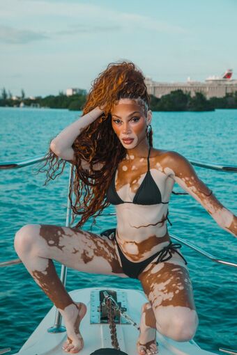 Winnie Harlow Foto Desnuda Filtrada OnlyFans 299